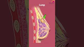 How is a Phyllodes Tumor Diagnosed  Kauvery Hospital Chennai  Tamil Shorts [upl. by Sergu]