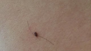 How To Get Rid of Skin Tags Naturally [upl. by Dominy926]