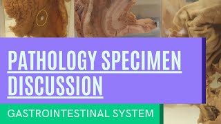 Pathology Specimen Discussion  Gastrointestinal System [upl. by Iv]