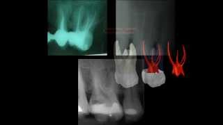 Primer molar superior [upl. by Aleil]