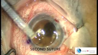 Perforating Keratoplasty PKP by Dr Alex Lange [upl. by Faina]