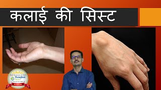 कलाईकीसिस्ट Wrist Ganglion Cyst Hindi [upl. by Teresita]