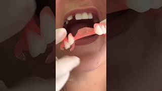 How To Fill Gaps Between Teeth With Artificial Teeth [upl. by Adidnere]