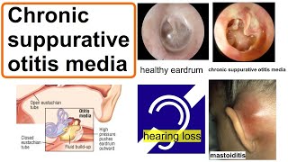 chronic suppurative otitis media [upl. by Macilroy]