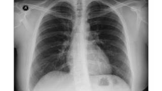 Breast Cancer  Chest xray  Metastases [upl. by Atekehs]