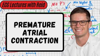 Premature Atrial Contractions  Day 2 ECG Challenge [upl. by Ferdy]