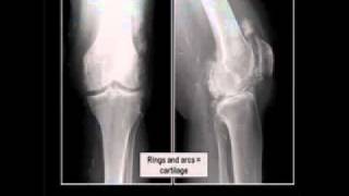 LearningRadiology 26 Soft Tissue Calcifications I [upl. by Jerrome]