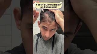 How to use derma roller for hair growth treatment [upl. by Krishna946]