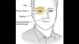 Cluster Headache [upl. by Tarkany]