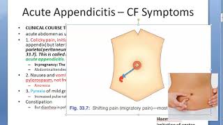 Surgery 836 Acute Appendicitis symptom sign clinical feature dunphy cough Blumberg rebound Rovsing [upl. by Kirrad]