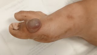 Hematom drainage or Abscess drainageآیا این هیماتوم باشه یا آبسی ؟viral explore india subscribe [upl. by Flossi280]