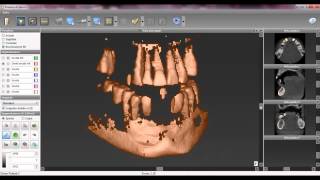 Tutorial n7 Estrazione virtuale dei denti in CoDiagnostiX [upl. by Ruff]