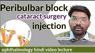 peribulbar block injection  peribulbar block  peribulbar block technique  hindiophthalmology [upl. by Chi]