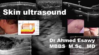 Skin Ultrasound [upl. by Itsirc889]