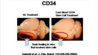 Stem Cell Therapy for Cerebral Palsy [upl. by Silberman]