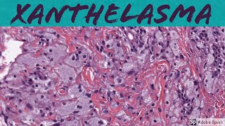 Xanthelasma Xanthoma of Eyelid 5Minute Pathology Pearls [upl. by Yragerg]