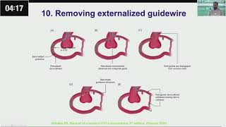 Retrograde CTO PCI Tips amp Tricks Wire Externalization by Dr Aftab khan [upl. by Acemahs]