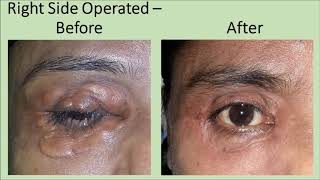 Large Xanthelasma Treatment  Xanthelasma Removal by Dr Ashutosh Shah Elegance Clinic Surat Gujarat [upl. by Enaira]