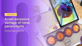 How to avoid excessive damage of renal parenchyma  Partial Nephrectomy [upl. by Acila]