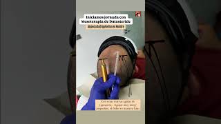 Mesoterapia Capilar Mesoterapia con Dutasteride para alopecia mesoterapia hair cabello salud [upl. by Atinihs]