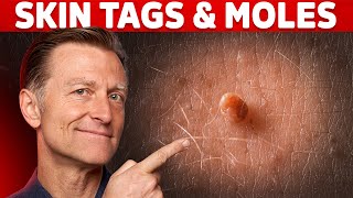 Use Iodine for Skin Tags and Warts – DrBerg on Skin Tag Removal [upl. by Attej]