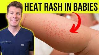 Doctor explains HEAT RASH miliaria in a baby  Causes symptoms treatment and prevention [upl. by Hermosa114]