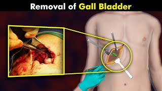 How Cholecystectomy Procedure Is Performed  Gallbladder Removal Surgery UrduHindi [upl. by Boyer]