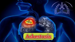 Pneumoconiosis 22  Asbestosis [upl. by Aisetra]