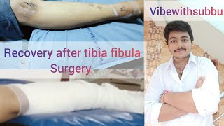 Tibia fibula surgery recovery vibewithsubbu recovery after leg surgery time taken for recovery [upl. by Winifred768]