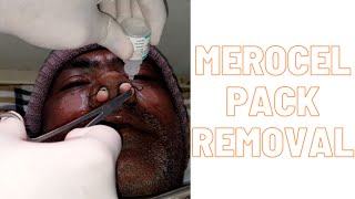 Merocel pack removal [upl. by Eislrahc]