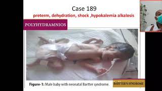 Case 189 hypokalemic metabolic alkalosis Bartter syndrome hyperprostaglandin Syndrome hypercalciu [upl. by Seldun]