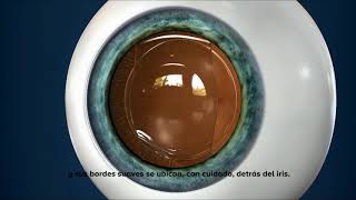 Cómo es la operación de cirugía refractiva con lente intraocular ICL [upl. by Elimay]