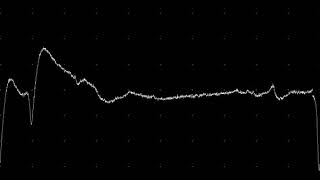 EMG teaching video 3 Positive Sharp Waves [upl. by Aikar154]