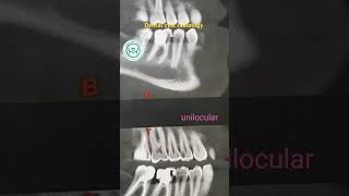 Dental cyst radiology حويصلات الفكين [upl. by Humph]