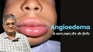 Angioedema How can one manage Angioedema  Angioedema के कारणलक्षणजॉंच और ट्रीटमेंट [upl. by Yrro]