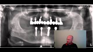 Oberkiefer Implantate auch ohne Knochenaufbau möglich [upl. by Iffar]