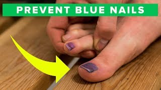 How to prevent blue toe nails  learn how to avoid black nails [upl. by Jovitta902]