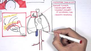 Lung Carcinoma Lung cancer [upl. by Lyrret824]