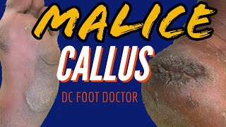 Malice Callus Severe Calluses and Fissures Size 13 Feet [upl. by Zandra]