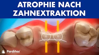 Atrophie nach Zahnextraktion © [upl. by Yerfoeg]