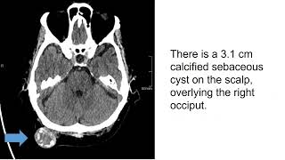 Calcified Cyst on Scalp [upl. by Sivrahc]