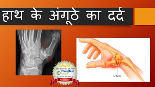 CMC arthritis Hindi [upl. by Corry477]