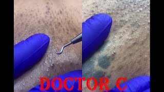 INFECTED INGROWN HAIR 03 [upl. by Ateuqirne]