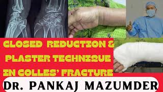 Colles’ fracture closed reduction distal radius ot youtube viral trending video boneartist [upl. by Chapnick424]