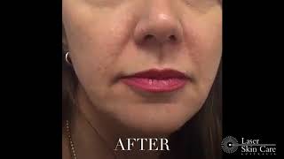 Liquid Facelift  Dermal Fillers Hollow Cheeks [upl. by Braeunig]