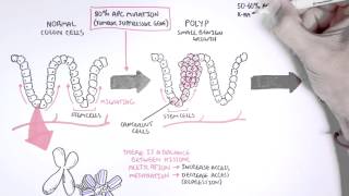 Colon Cancer Carcinogensis [upl. by Anaahs775]