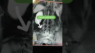 Psoas Abscess Mri Lumbar Spine viral mri shorts [upl. by Cinimmod]