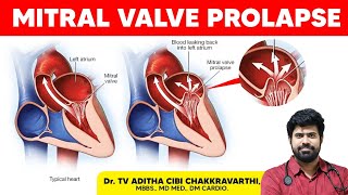 Mitral valve prolapse in tamil  treatment for mitral valve prolapse  doctoradithacibi [upl. by Anjela]