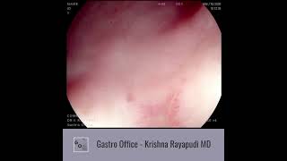 Gastric Ulcer video [upl. by Nosrac761]