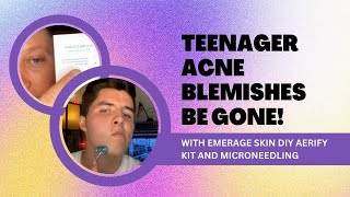 TEENAGER ACNE BLEMISHES BE GONE WITH EMERAGE SKIN DIY AERIFY KIT AND MICRONEEDLING  Dr Jason Emer [upl. by Nennek991]